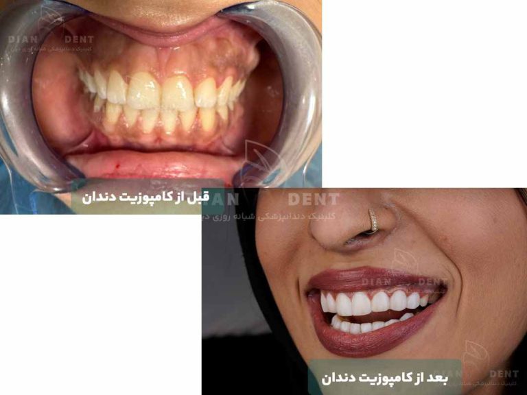Before and after dental composite 2