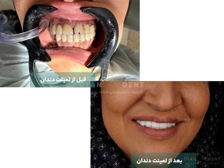 نمونه کار قبل و بعد لمینت دندان 3
