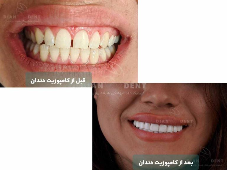نمونه کار قبل و بعد کامپوزیت دندان