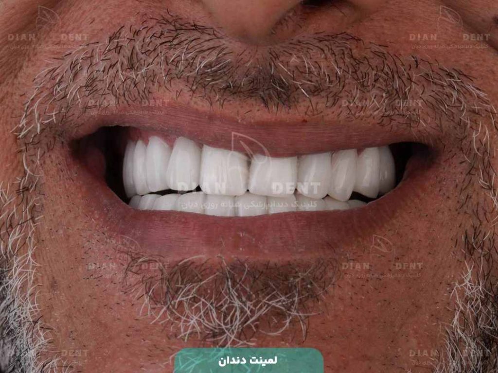 نمونه کار لمینت دندان در دیان 1