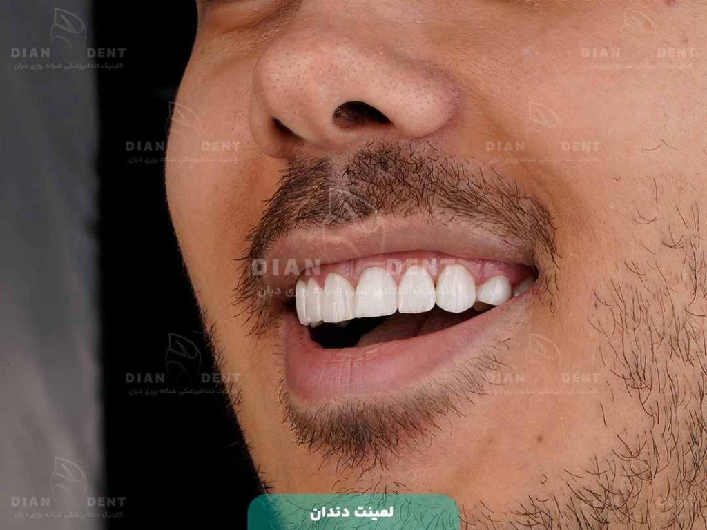 نمونه کار لمینت دندان در دیان 3
