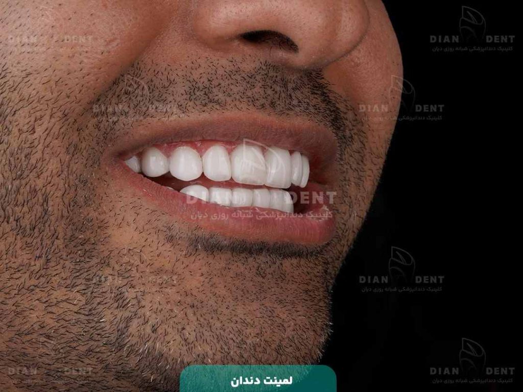 نمونه کار لمینت دندان در دیان
