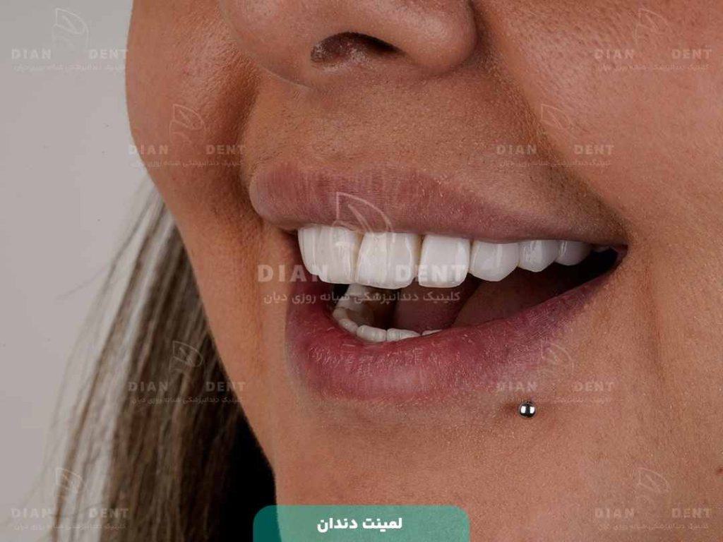 نمونه کار لمینت دندان در دیان 4