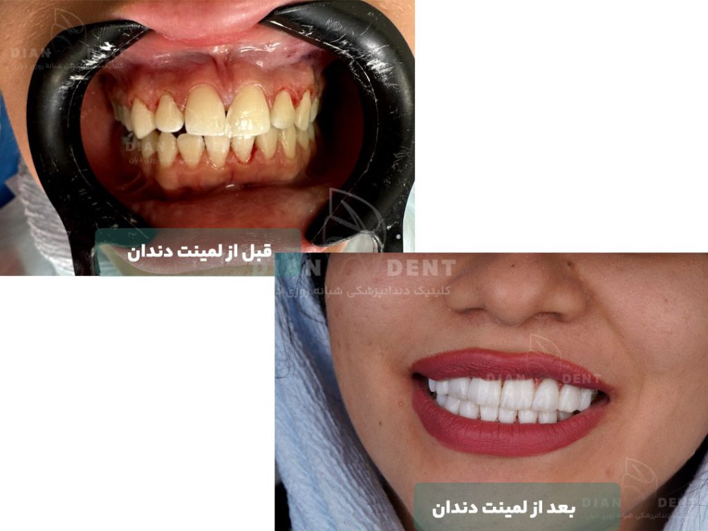 نمونه کار قبل و بعد از لمینت دندان