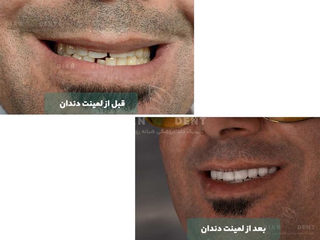 نمونه کار قبل و بعد از لمینت دندان