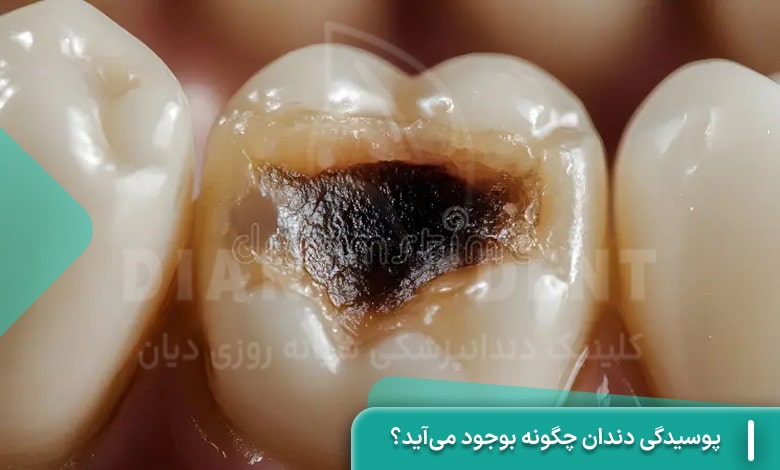 پوسیدگی دندان چگونه بوجود می‌آید