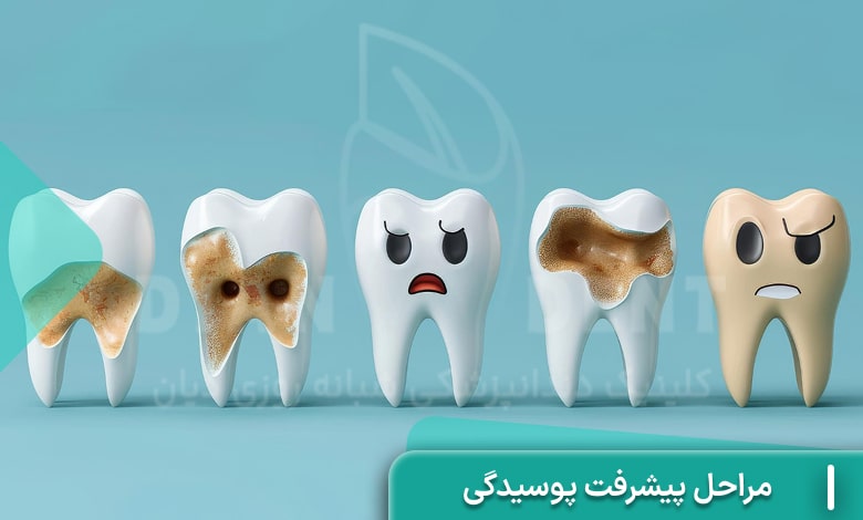 مراحل پیشرفت پوسیدگی