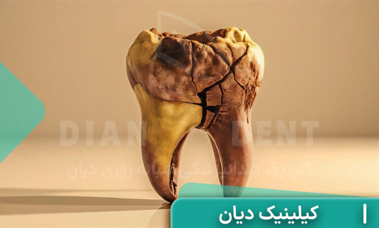 پوسیدگی دندان