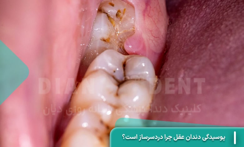 پوسیدگی دندان عقل چرا دردسرساز است