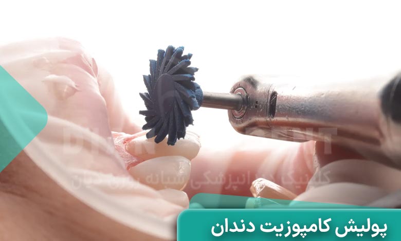 پولیش کامپوزیت دندان