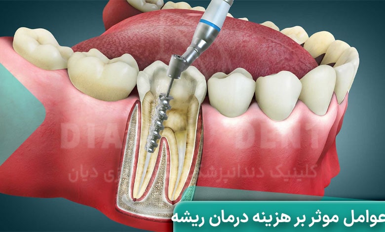 عوامل موثر بر هزینه درمان ریشه
