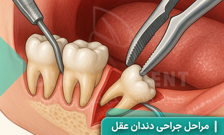 مراحل جراحی دندان عقل