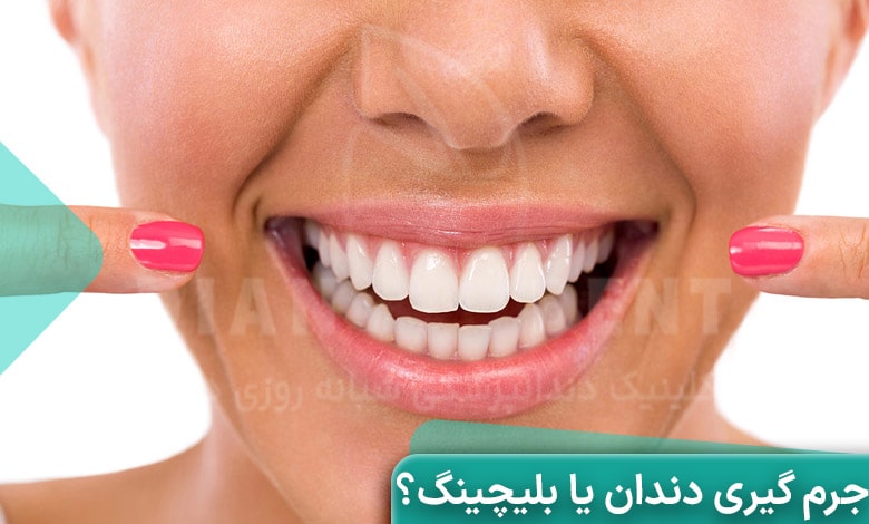 جرم گیری دندان یا بلیچینگ؟