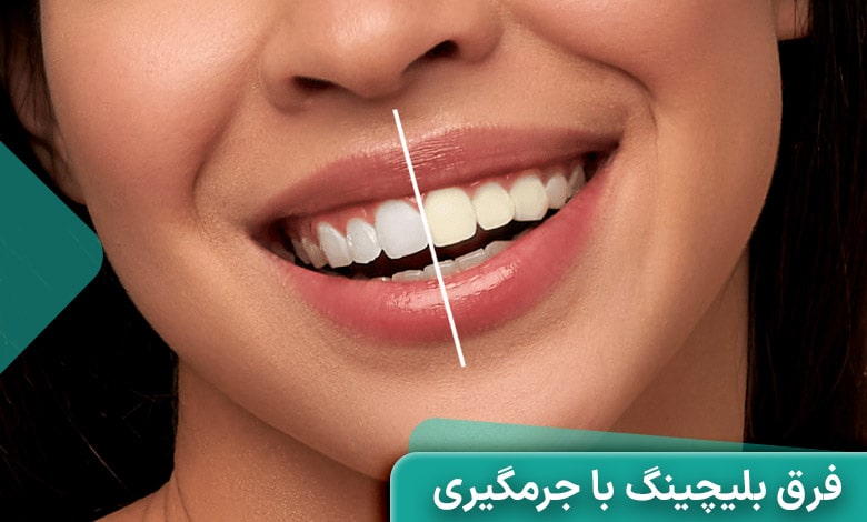 کدام بهتر است؟ جرم گیری یا بلیچینگ دندان