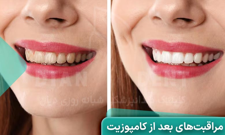 چرا مراقبت بعد از کامپوزیت مهم است؟