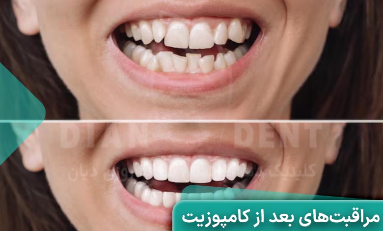مراقبت های بعد از کامپوزیت دندان
