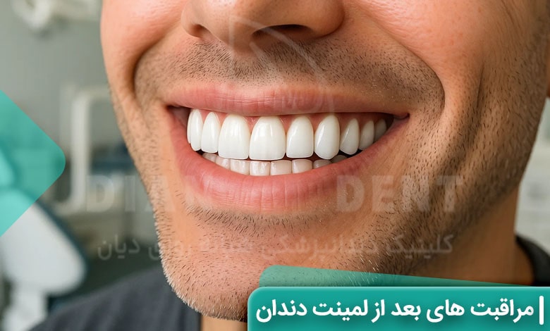مراقبت های بعد از لمینت دندان