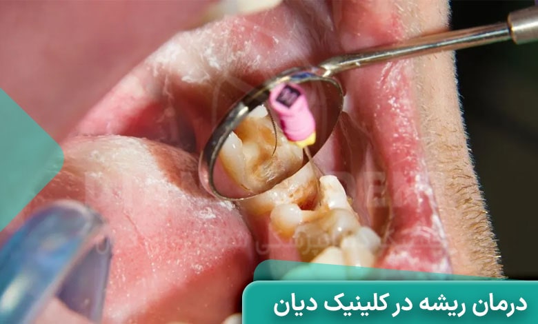 عصب کشی دندان در کلینیک دیان