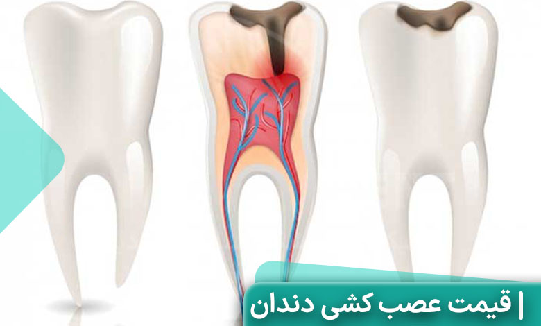 هزینه عصب کشی دندان در کلینیک دیان