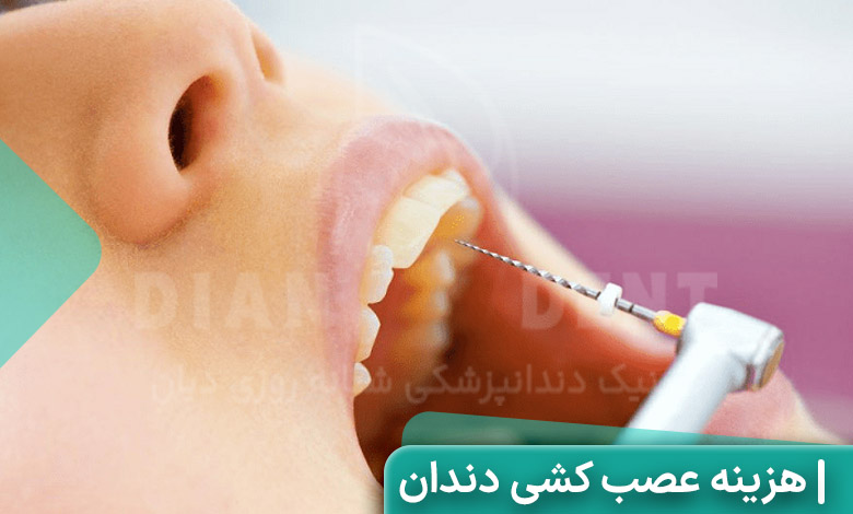 هزینه عصب کشی دندان