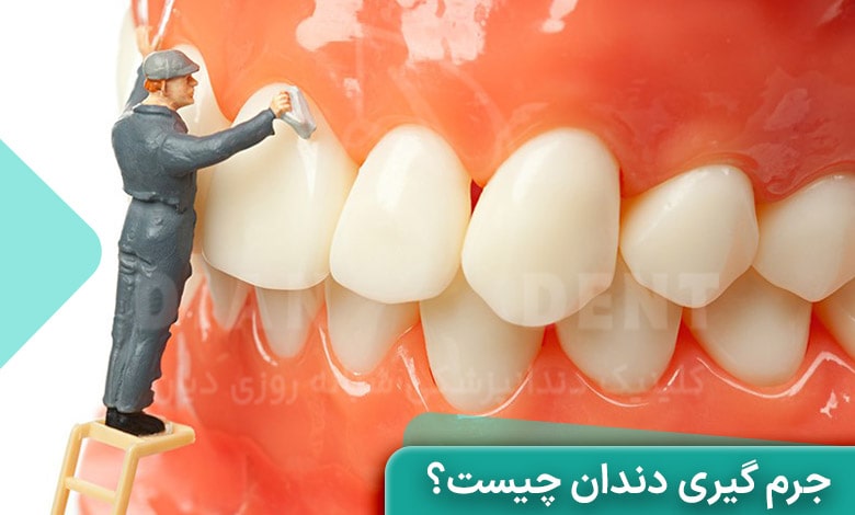 جرم گیری دندان چیست