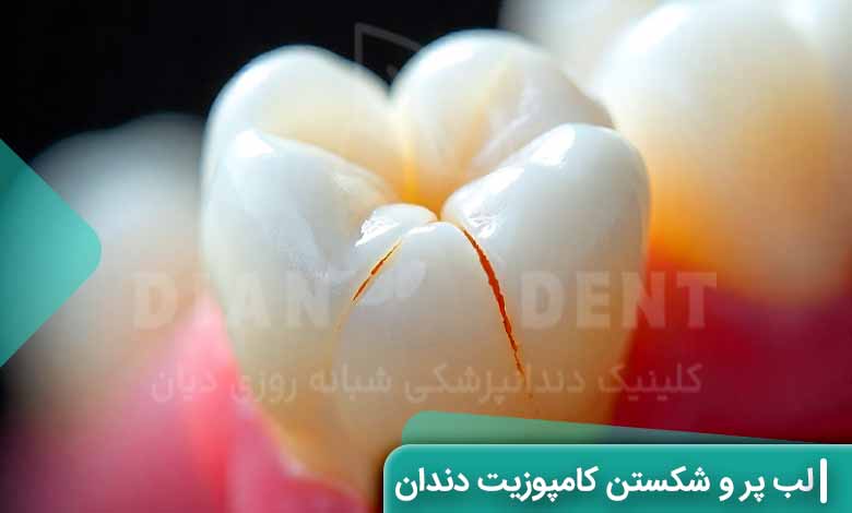 لب پر شدن و شکستن کامپوزیت دندان