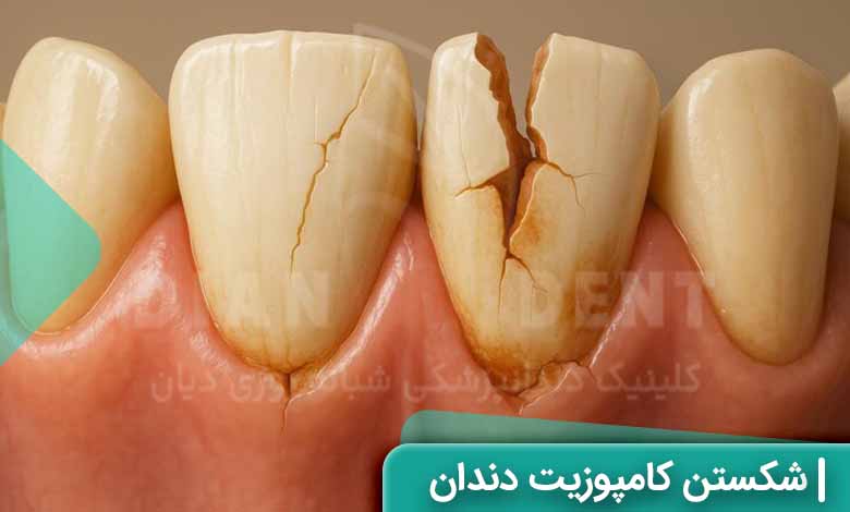 چرا کامپوزیت دندان می شکند؟