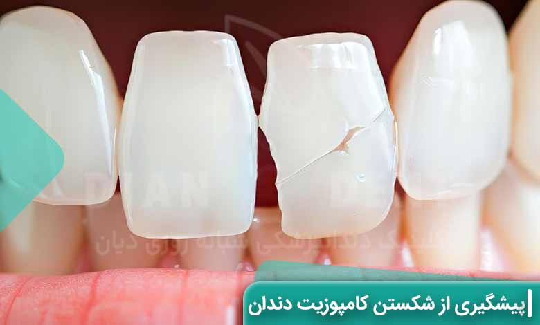 چگونه از شکستن کامپوزیت ونیر پیشگیری کنیم؟