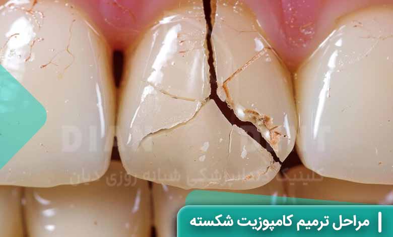 مراحل ترمیم کامپوزیت ونیر شکسته