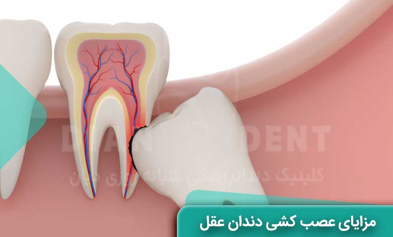 مزایای عصب کشی دندان عقل