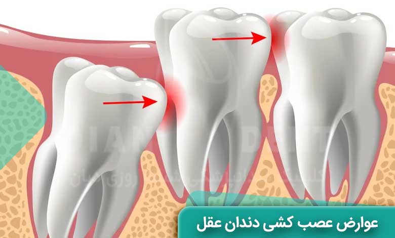 عوارض عصب کشی دندان عقل