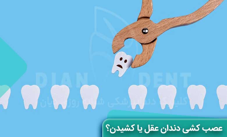 دندان عقل را بکشیم یا عصب کشی کنیم؟