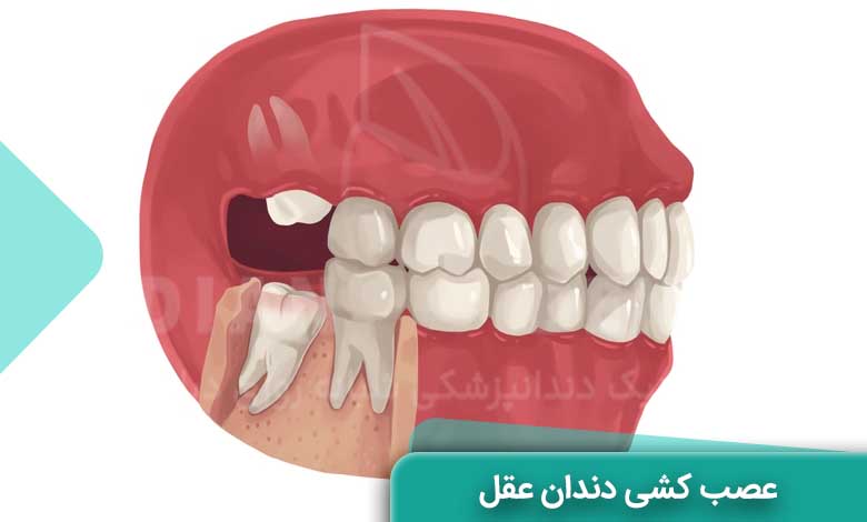 عصب کشی دندان عقل