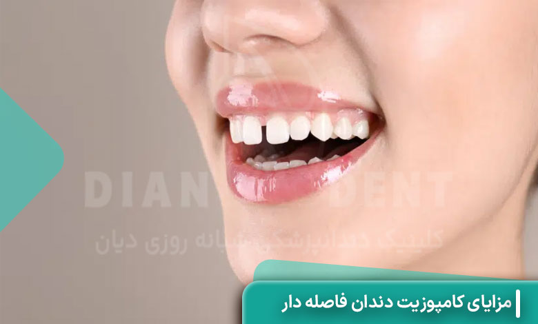 مزایای کامپوزیت دندان فاصله‌ دار