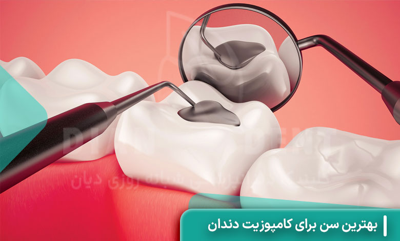 بهترین سن برای کامپوزیت دندان