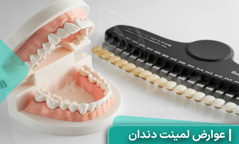 عوارض لمینت دندان