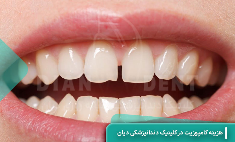 هزینه کامپوزیت در کلینیک دندانپزشکی دیان