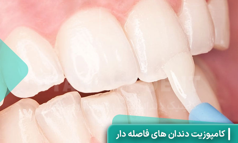 کامپوزیت دندان‌ های فاصله‌ دار