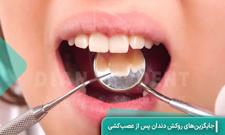 جایگزین‌های روکش دندان پس از عصب‌کشی