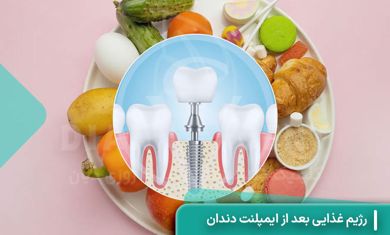 رژیم غذایی بعد از ایمپلنت دندان