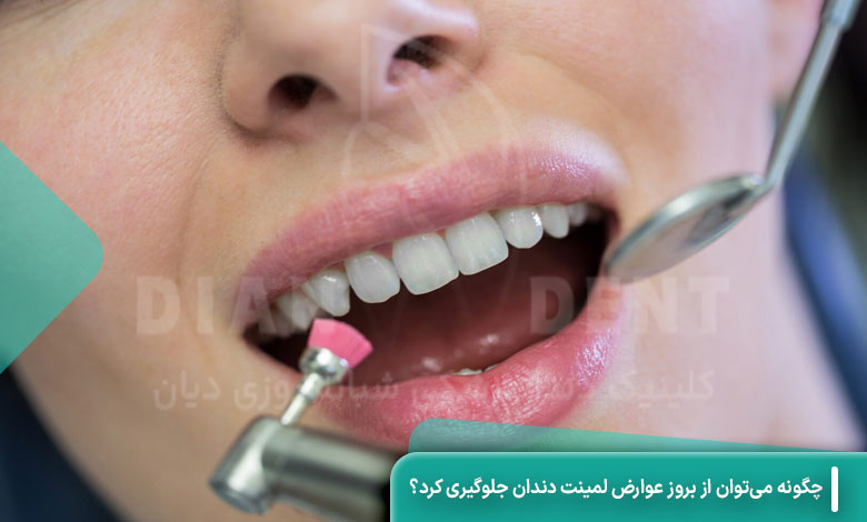 چگونه می‌توان از بروز عوارض لمینت دندان جلوگیری کرد؟