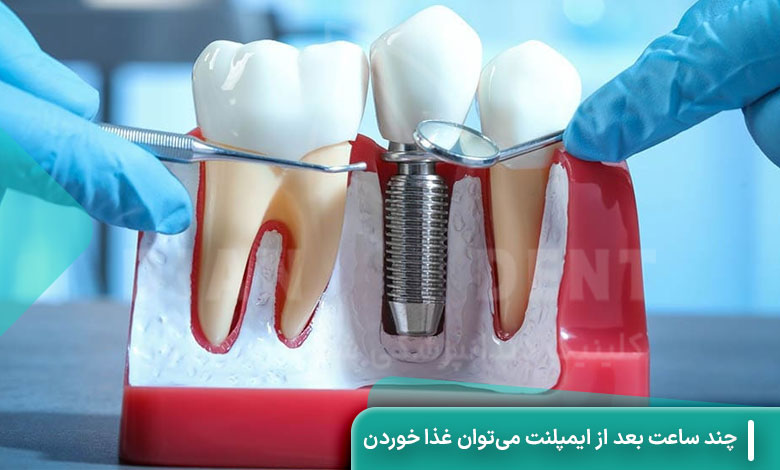 چند ساعت بعد از ایمپلنت می‌توان غذا خوردن را شروع کرد؟