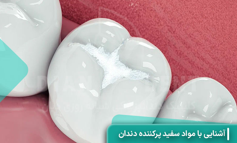 آشنایی با مواد سفید پرکننده دندان