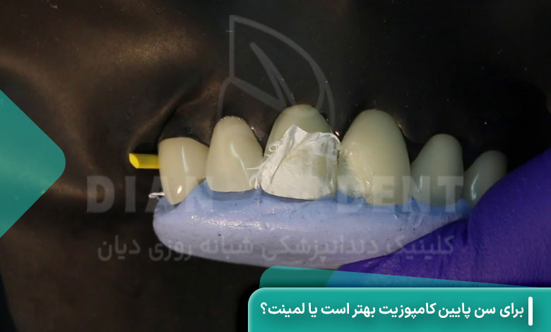 برای سن پایین کامپوزیت بهتر است یا لمینت؟
