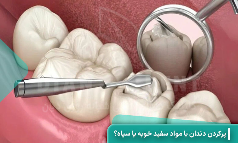پرکردن دندان با مواد سفید خوبه یا سیاه؟