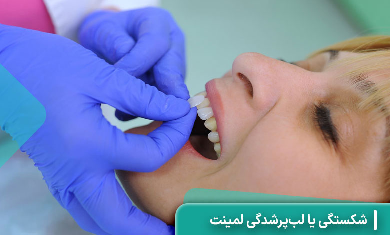 شکستگی یا لب‌پرشدگی لمینت