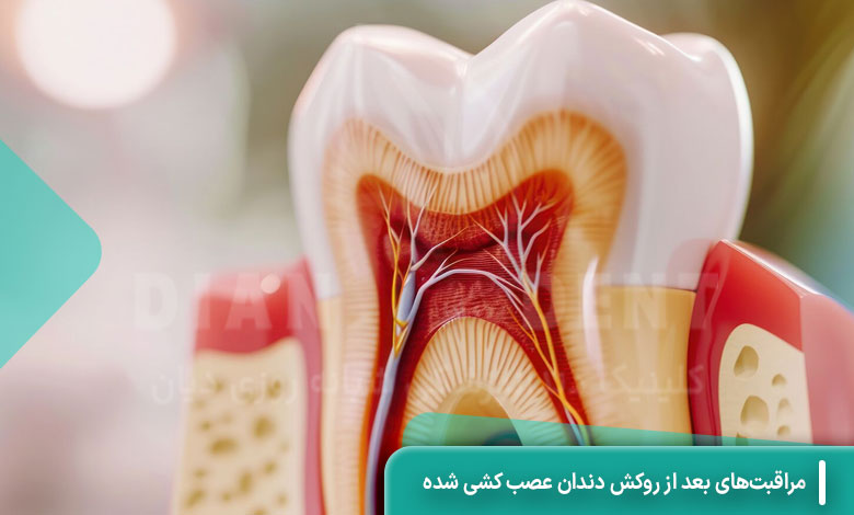 فاصله بین عصب‌کشی و روکش دندان چقدر باید باشد؟