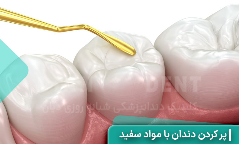 پر کردن دندان با مواد سفید