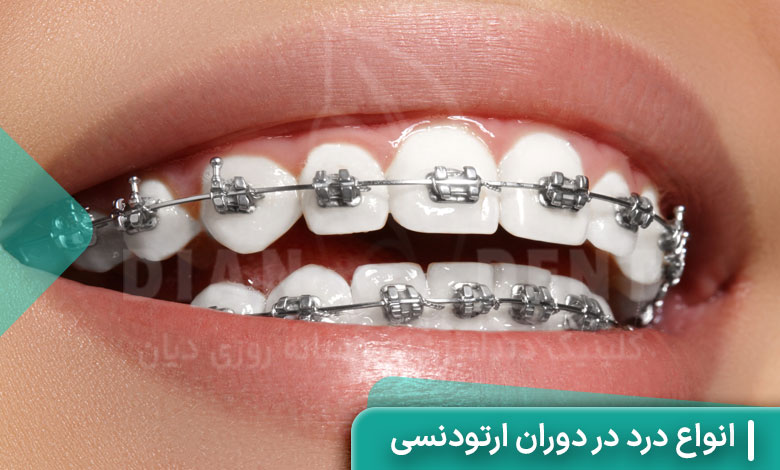انواع درد در دوران ارتودنسی
