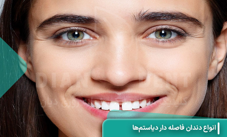 انواع دندان فاصله ‌دار (دیاستم‌ها)